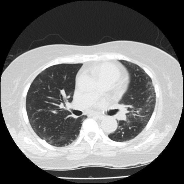 File:Acute interstitial pneumonitis (Radiopaedia 45404-49444 Axial lung window 51).jpg