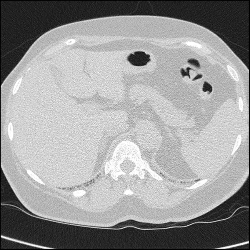 Acute interstitial pneumonitis (Radiopaedia 45404-49453 Axial lung window 78).jpg