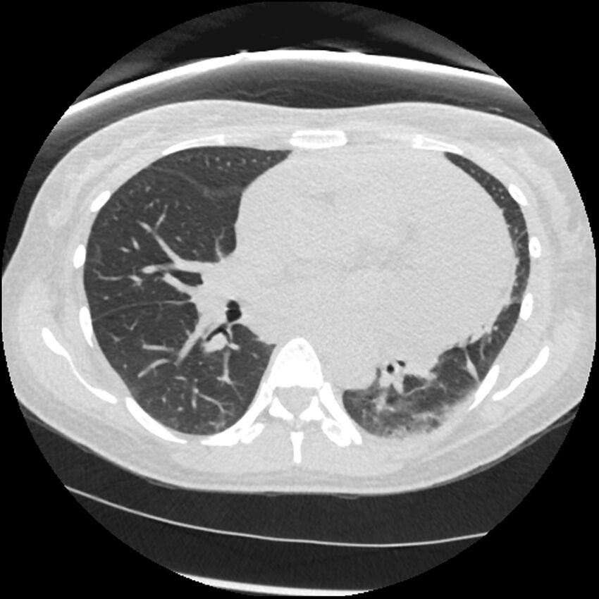 Acute lupus nephritis (Radiopaedia 45832-50107 Axial lung window 46).jpg