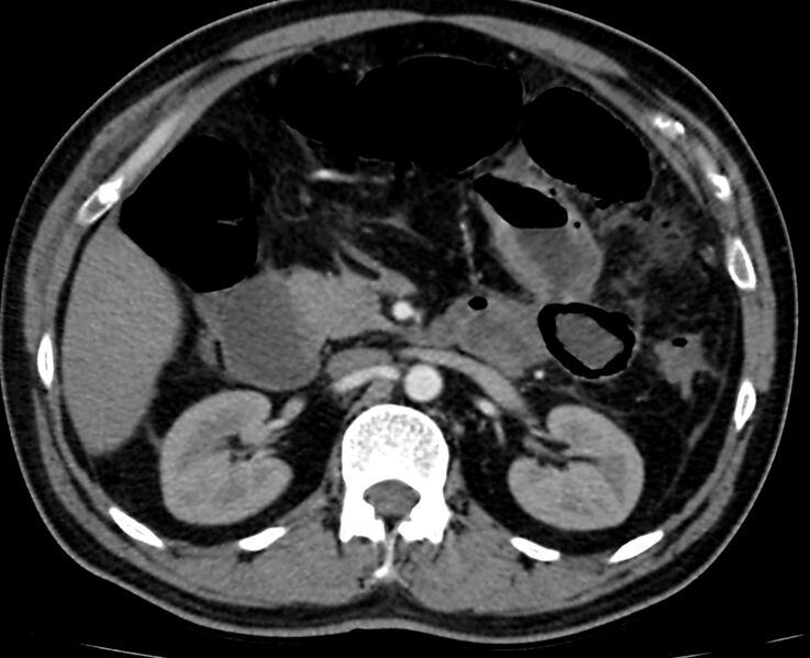 File:Acute mesenteric ischemia - superior mesenteric artery thrombosis (Radiopaedia 73947-84776 Axial C+ arterial phase 34).jpg