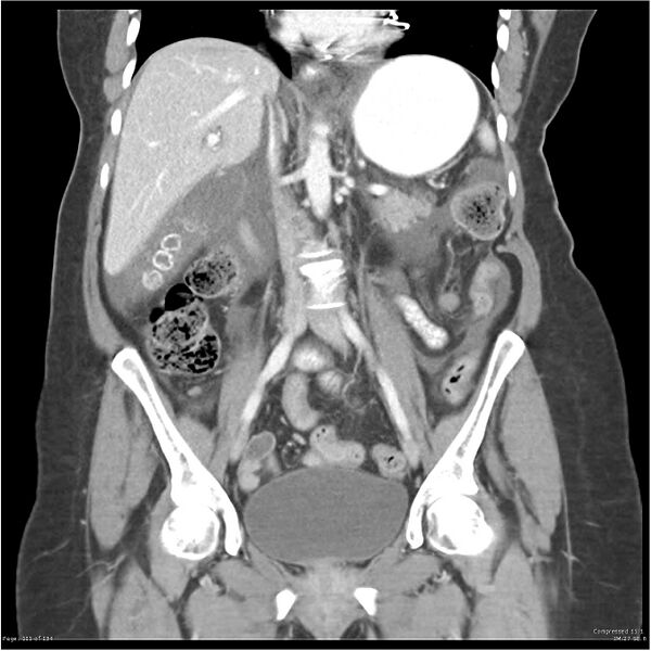 File:Acute pancreatitis (Radiopaedia 19136-19117 Coronal C+ portal venous phase 21).jpg