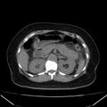 Acute pancreatitis - Balthazar C (Radiopaedia 26569-26714 Axial non-contrast 34).jpg