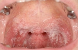 Oral candidiasis can occur following incorrect use of steroid inhaler[5]