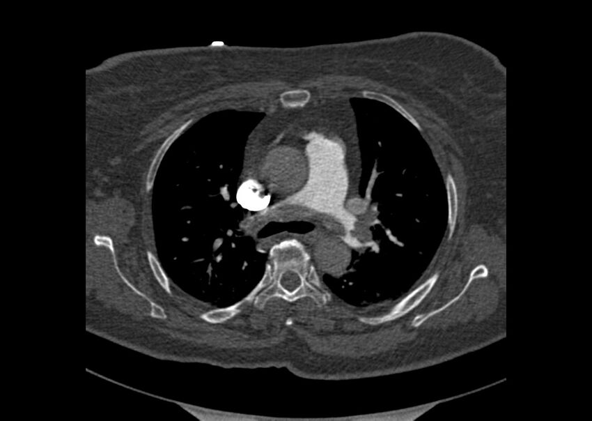 Acute pulmonary embolism (Radiopaedia 29938-30466 Axial C+ CTPA 39).jpg
