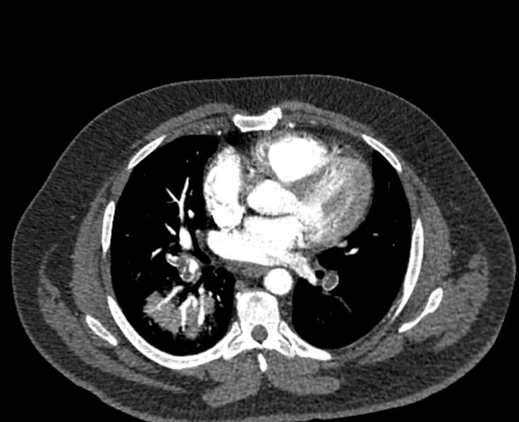 File:Acute pulmonary embolism with pulmonary infarcts (Radiopaedia 77688-89908 Axial C+ CTPA 35).jpg