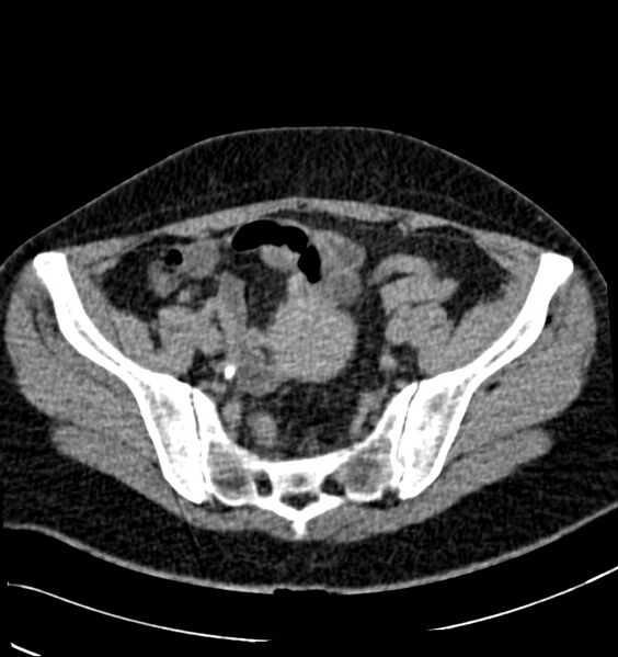 File:Acute pyelonephritis (Radiopaedia 40264-42816 Axial renal excretory phase 28).jpg