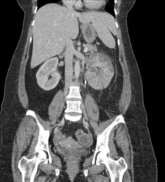 File:Acute pyelonephritis with renal vein thrombosis (Radiopaedia 58020-65053 Coronal renal parenchymal phase 43).jpg