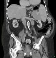 Acute renal failure post IV contrast injection- CT findings (Radiopaedia 47815-52559 Coronal C+ portal venous phase 15).jpg