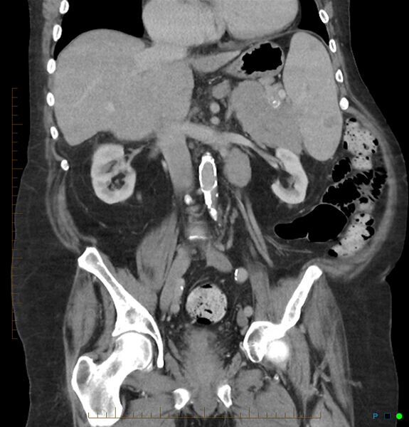 File:Acute renal failure post IV contrast injection- CT findings (Radiopaedia 47815-52559 Coronal C+ portal venous phase 15).jpg