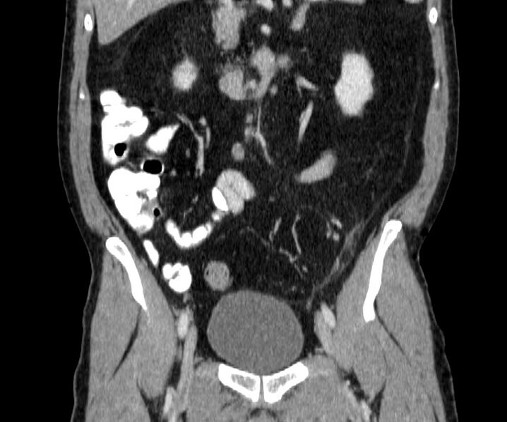 File:Acute sigmoid colon diverticulitis (Radiopaedia 55507-61976 Coronal C+ portal venous phase 74).jpg