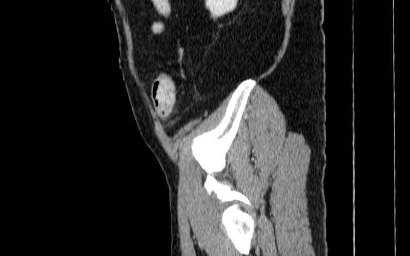 File:Acute sigmoid colon diverticulitis (Radiopaedia 55507-61976 Sagittal C+ portal venous phase 120).jpg