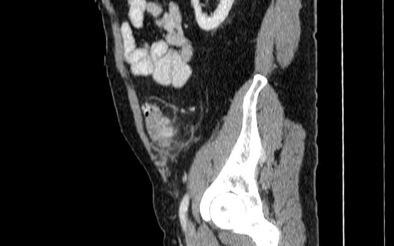 File:Acute sigmoid colon diverticulitis (Radiopaedia 55507-61976 Sagittal C+ portal venous phase 86).jpg