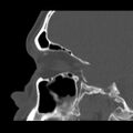 Acute sinusitis (Radiopaedia 23161-23215 Sagittal bone window 24).jpg