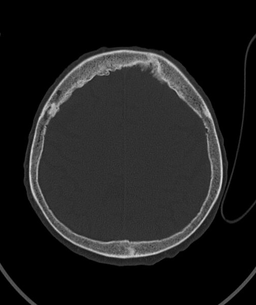 File:Acute traumatic subdural hematoma (Radiopaedia 82921-97257 Axial bone window 34).jpg