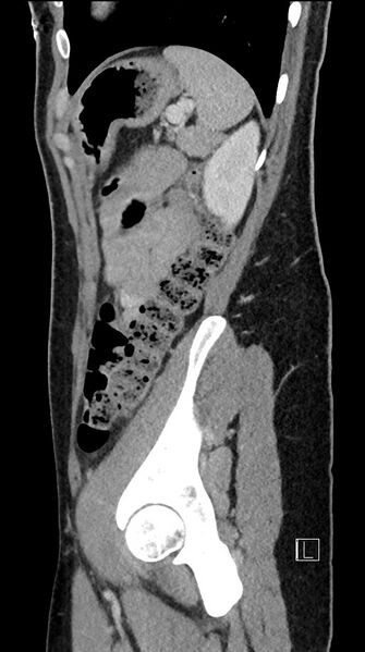 File:Acute uncomplicated appendicitis (Radiopaedia 61374-69304 Sagittal C+ portal venous phase 24).jpg