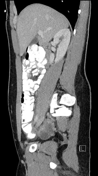 File:Acute uncomplicated appendicitis (Radiopaedia 61374-69304 Sagittal C+ portal venous phase 68).jpg