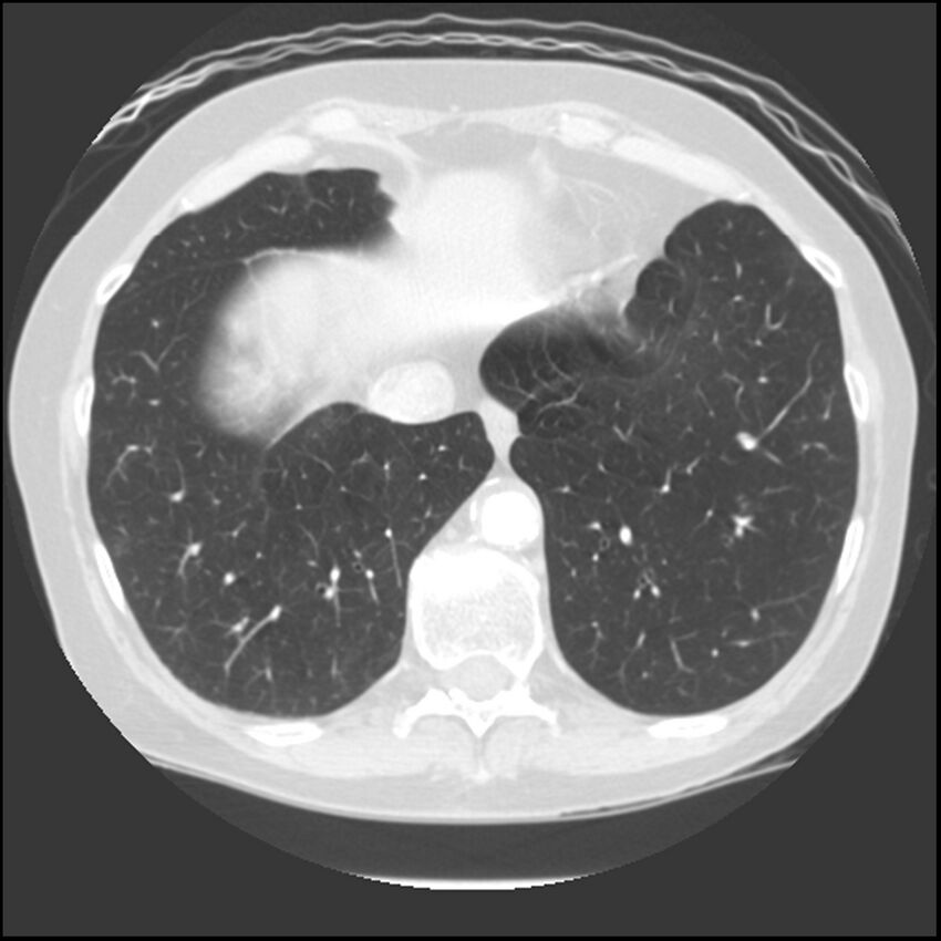 Adenocarcinoma of the lung (Radiopaedia 41015-43755 Axial lung window 97).jpg