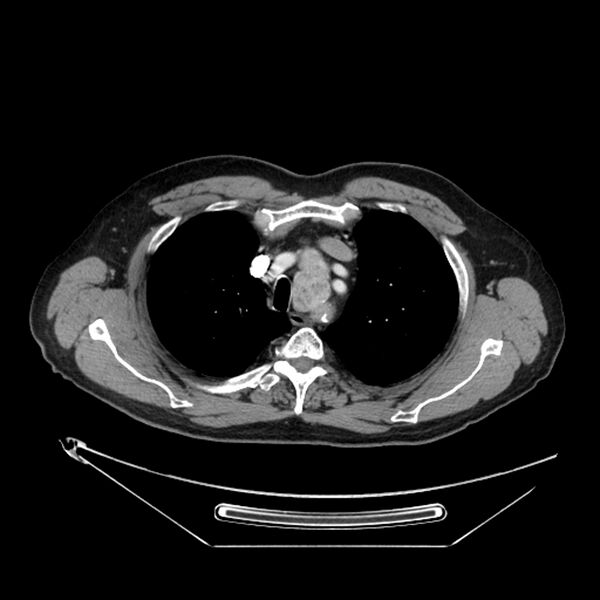 File:Adenocarcinoma of the lung (Radiopaedia 44876-48759 Axial C+ portal venous phase 19).jpg
