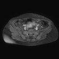 Adenomyoma of the uterus (huge) (Radiopaedia 9870-10438 Axial T1 C+ fat sat 24).jpg