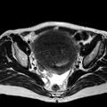 Adenomyoma of the uterus (huge) (Radiopaedia 9870-10438 Axial T2 21).jpg