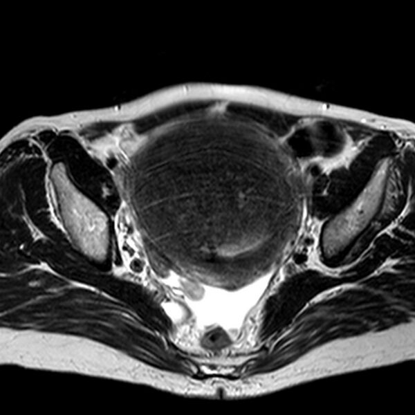 File:Adenomyoma of the uterus (huge) (Radiopaedia 9870-10438 Axial T2 21).jpg