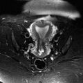 Adenomyosis of the uterus (Radiopaedia 9869-10437 Axial T2 3).jpg