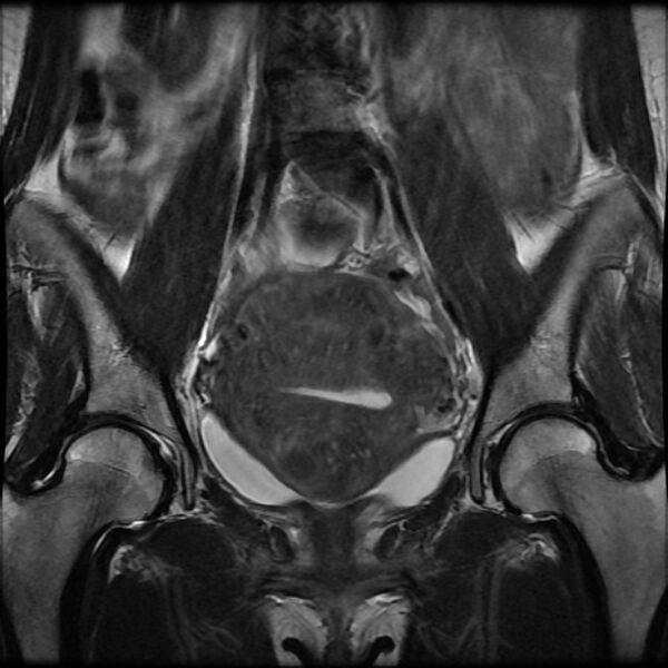 File:Adenomyosis on MRI (Radiopaedia 29328-29780 Coronal T2 9).jpg