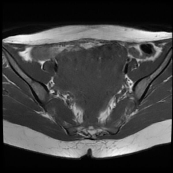 File:Adenomyosis within a septate uterus (Radiopaedia 69963-79981 Axial T1 13).jpg