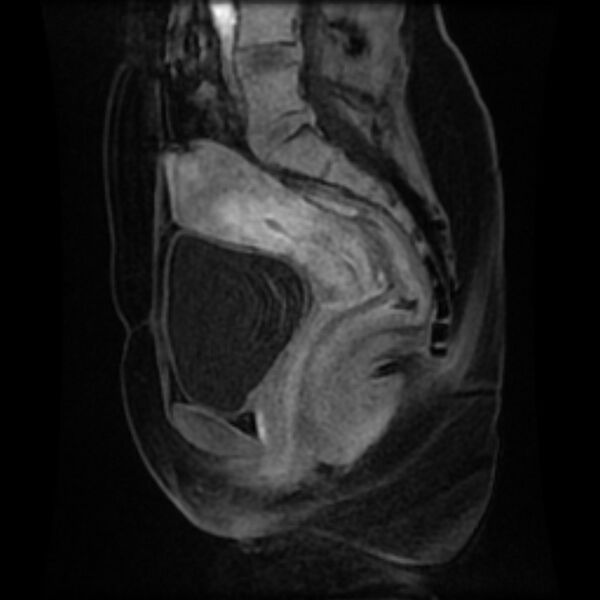 File:Adenomyosis within a septate uterus (Radiopaedia 69963-79981 Sagittal LAVA-Dyn 17).jpg