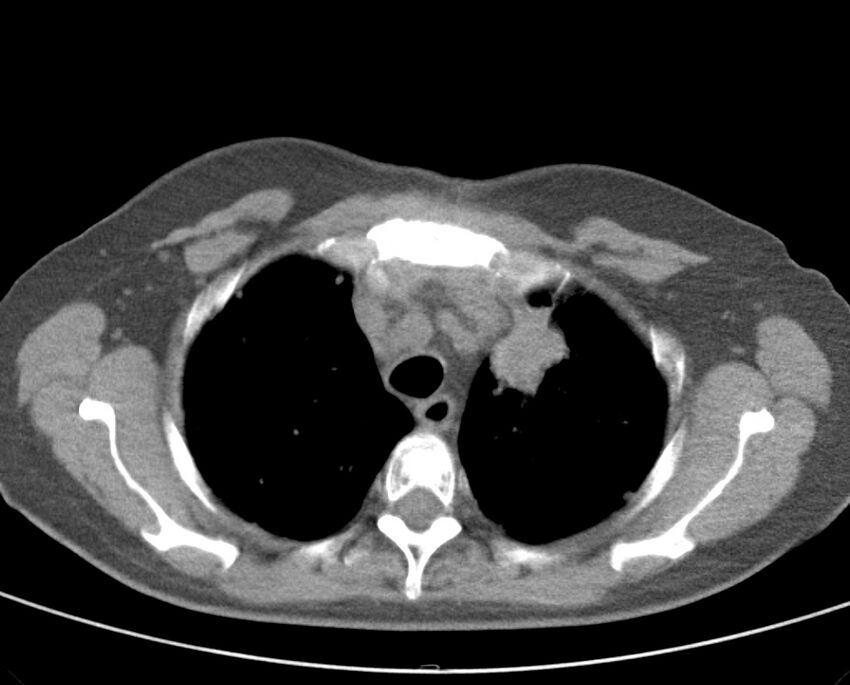 Adenosquamous lung carcinoma (Radiopaedia 22035-22030 non-contrast 19).jpg