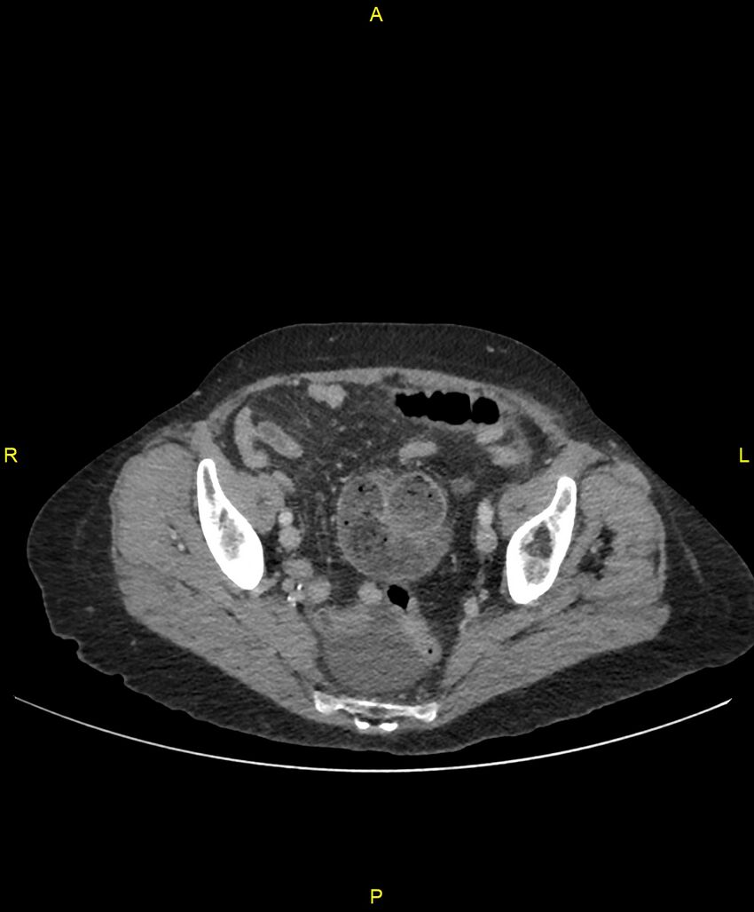 Adhesional small bowel obstruction (Radiopaedia 85402-101024 Axial C+ portal venous phase 239).jpg