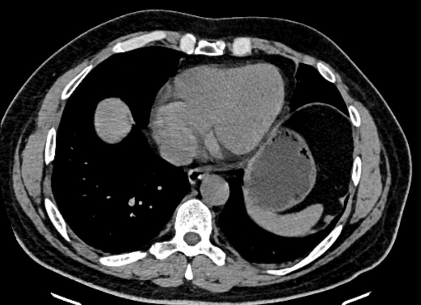 Adrenal metastases (Radiopaedia 73082-83791 Axial non-contrast 9).jpg