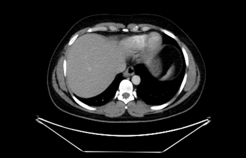 File:Adrenocortical carcinoma (Radiopaedia 80134-93438 Axial C+ portal venous phase 19).jpg
