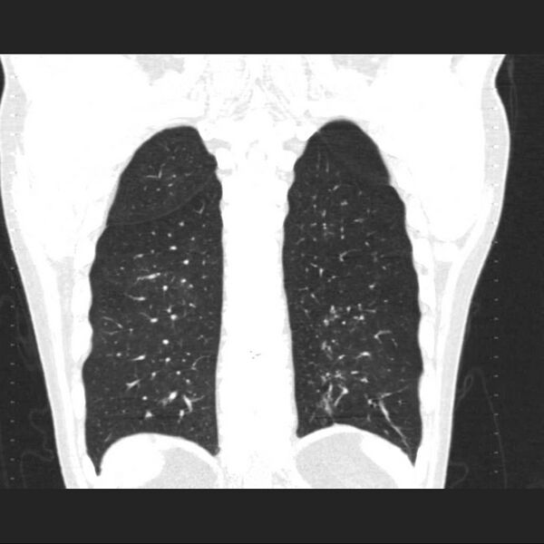File:Allergic bronchopulmonary aspergillosis (Radiopaedia 21386-21320 Coronal lung window 15).jpg