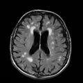 Alzheimer disease (Radiopaedia 10738-11199 Axial FLAIR 14).jpg