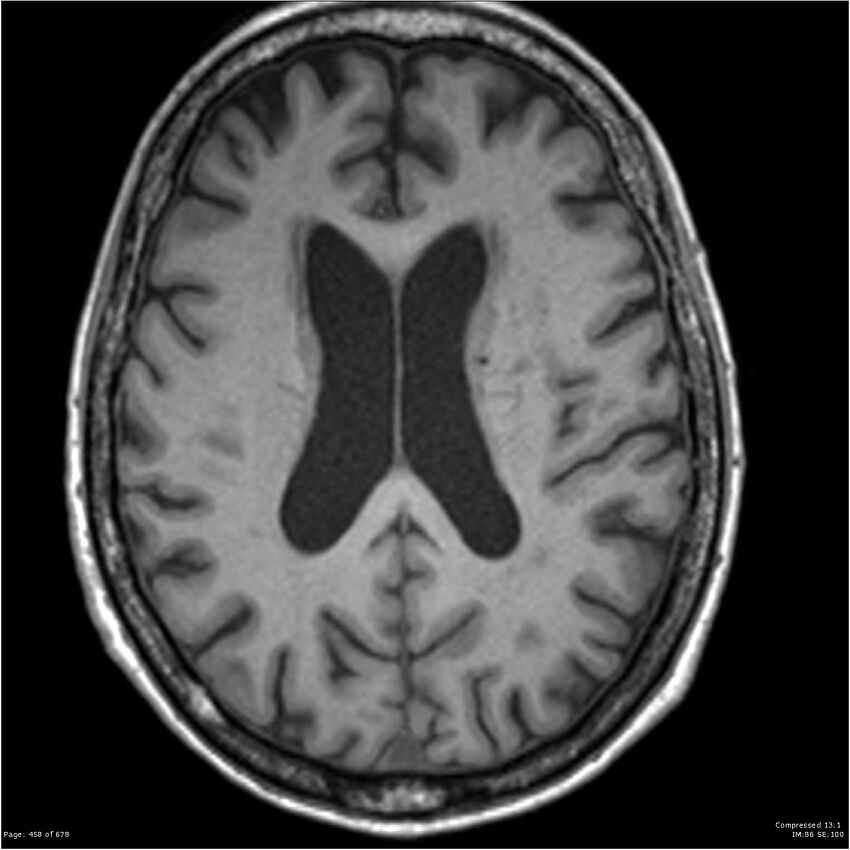 Alzheimer disease (Radiopaedia 22196-22226 Axial T1 40).jpg