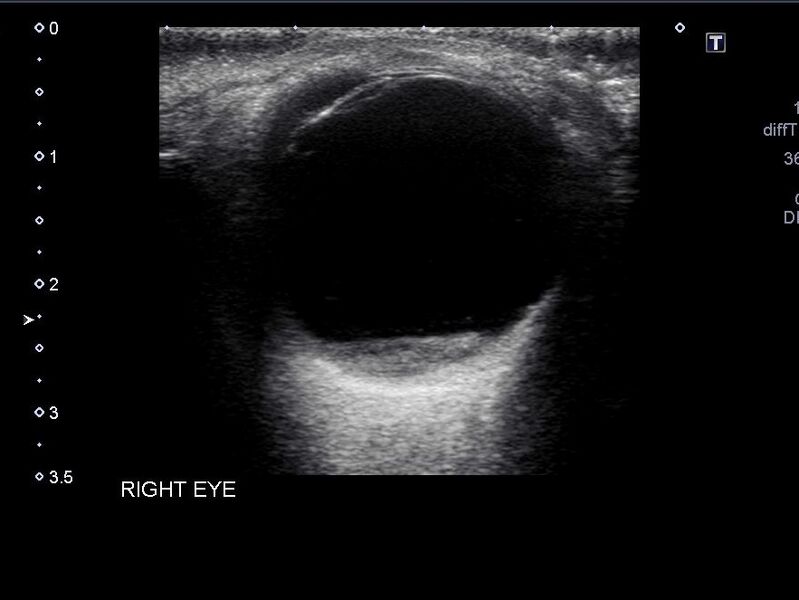 File:Amelanotic retinal melanoma (Radiopaedia 60667-68413 C 1).jpg
