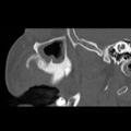 Ameloblastic fibro-odontoma (Radiopaedia 18843-18780 bone window 12).jpg