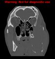 Ameloblastoma (Radiopaedia 13276-13280 Coronal non-contrast 12).jpg