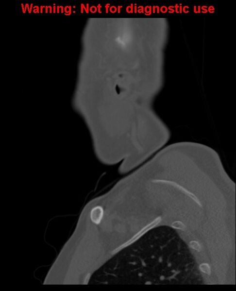 File:Ameloblastoma (Radiopaedia 33126-34164 Sagittal bone window 64).jpg
