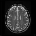 Amnestic syndrome secondary to hypoxic brain injury (Radiopaedia 24743-25004 T2 14).jpg