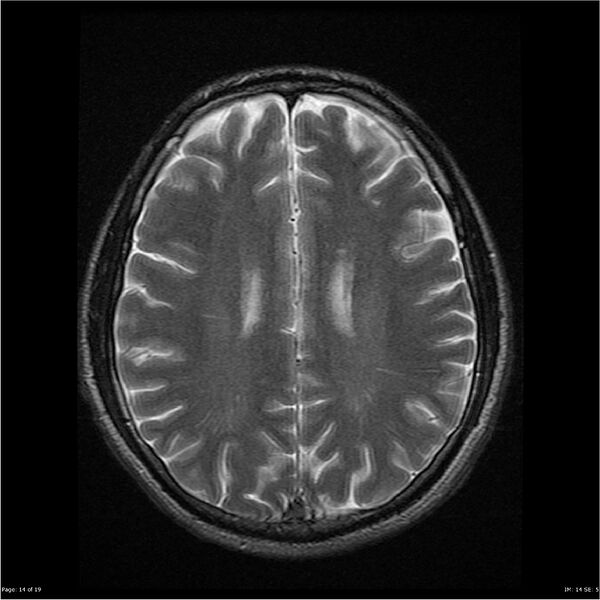 File:Amnestic syndrome secondary to hypoxic brain injury (Radiopaedia 24743-25004 T2 14).jpg