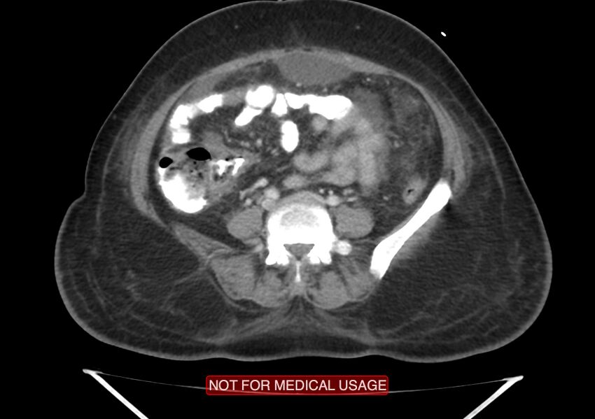 Amoebic enterocolitis with liver abscess (Radiopaedia 35100-36609 A 54).jpg
