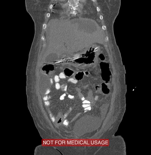 File:Amoebic enterocolitis with liver abscess (Radiopaedia 35100-36609 B 28).jpg