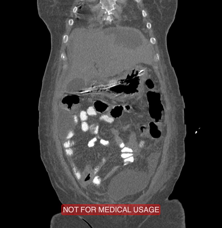Amoebic enterocolitis with liver abscess (Radiopaedia 35100-36609 B 28).jpg