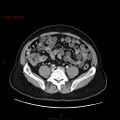 Ampullary carcinoma (Radiopaedia 56396-63056 C 68).jpg