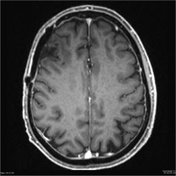 File:Anaplastic meningioma with recurrence (Radiopaedia 34452-35788 Axial T1 C+ 103).jpg