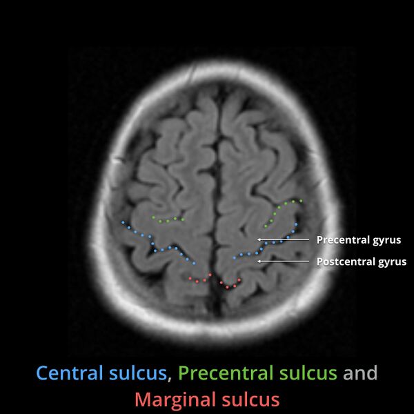 File:Anatomy- sulci of the brain (Radiopaedia 33834-34995 Central sulcus 6).jpg