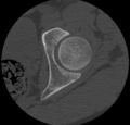 Aneurysmal bone cyst of ischium (Radiopaedia 25957-26094 B 2).png