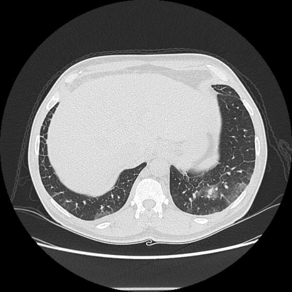 File:Angioinvasive aspergellosis (Radiopaedia 66995-76315 Axial lung window 45).jpg
